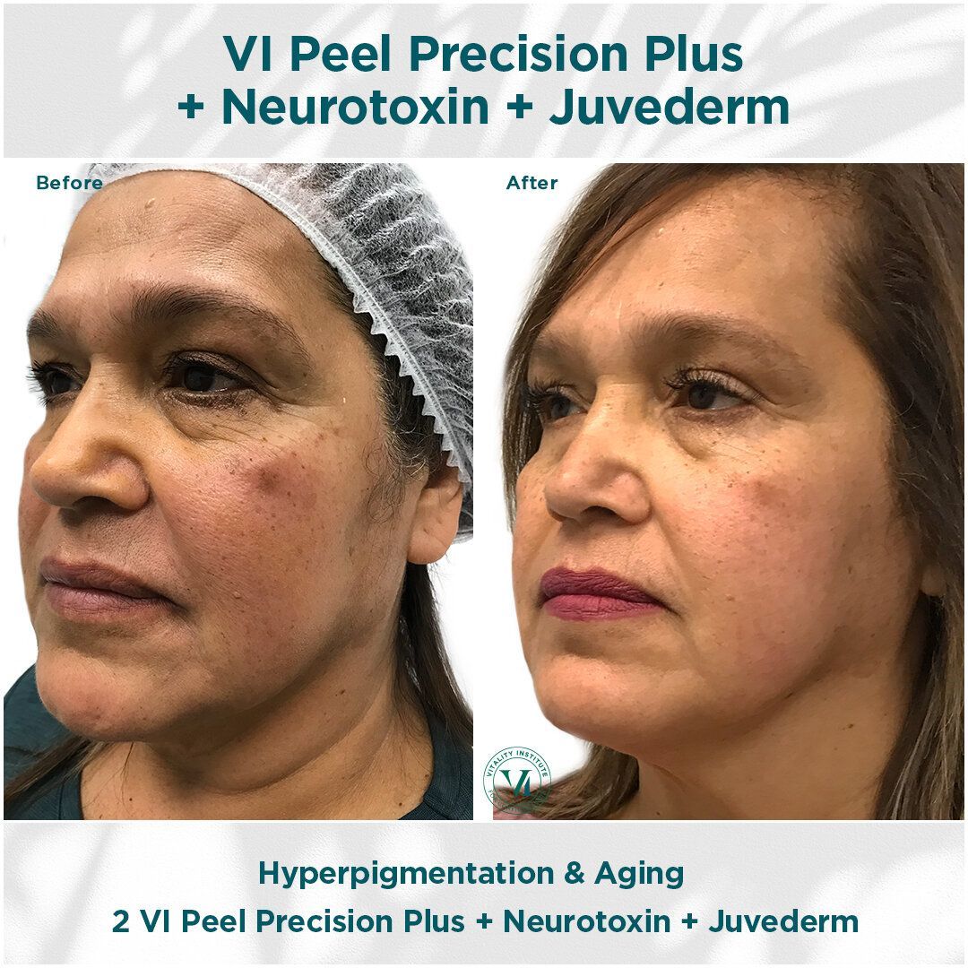 VI CHEMICAL PEELS BEFORE AND AFTER