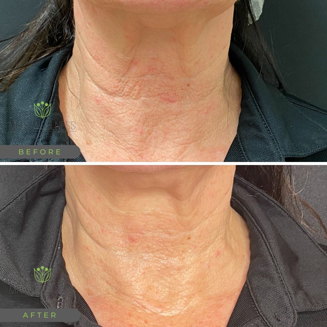Before and after for neck