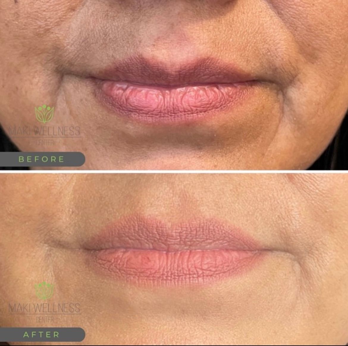JUVÉDERM before and after