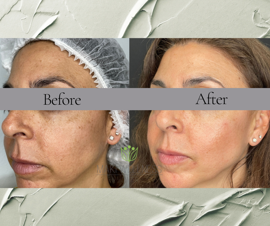 Before and after Chemical Peels in Maki Wellness