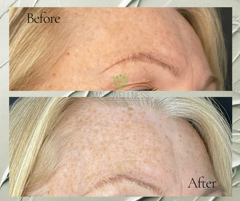 Before and after Chemical Peels in Maki Wellness
