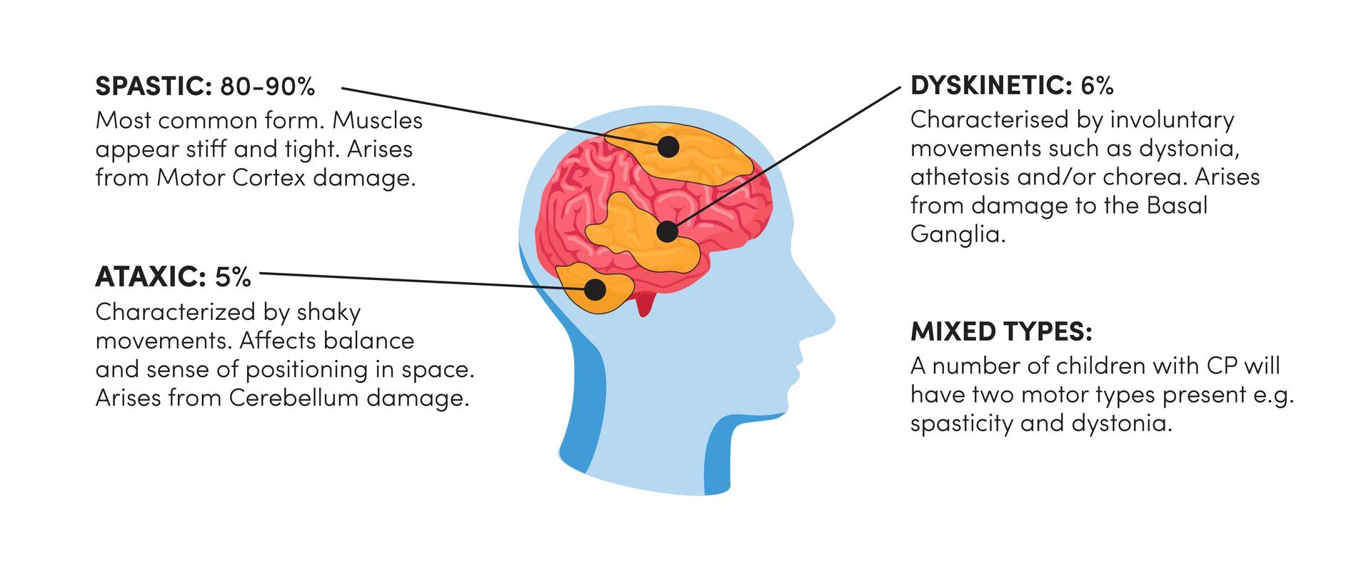 Descriptive illustration showing the 3 primary types of Cerebral PalsyP