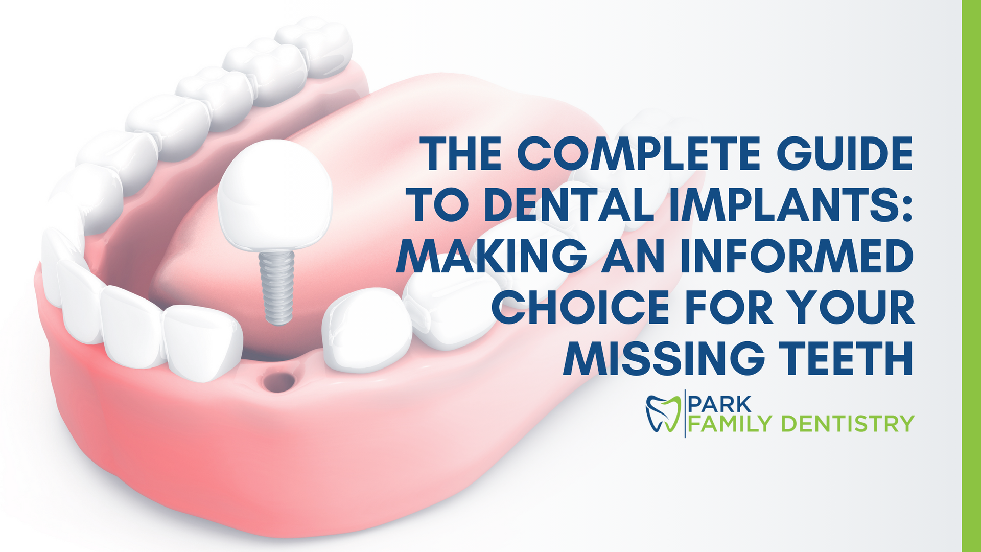Dental Model of Natural Teeth and Dental Implant with title Dental Implant Treatment Overview