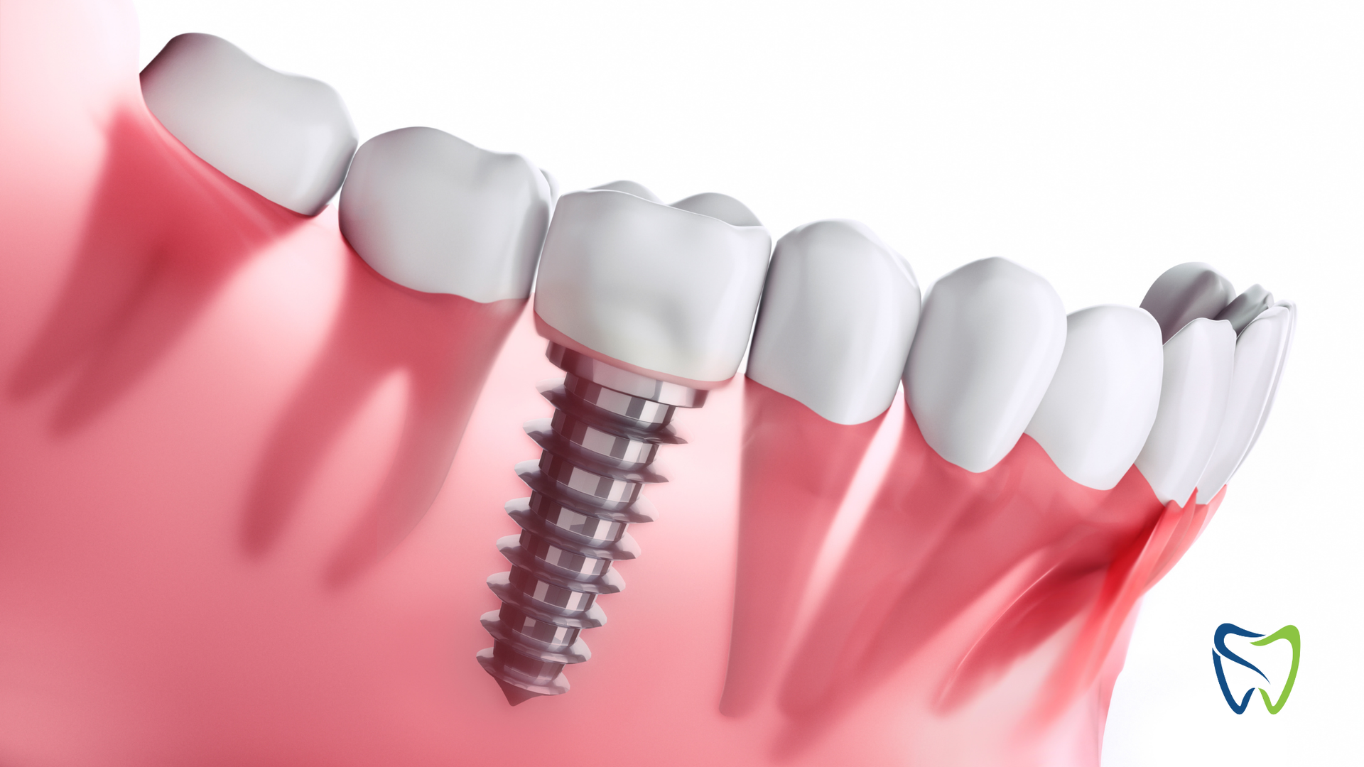 Dental implant in a jaw, with other teeth, rendered in a pink, red, and white 3D illustration.