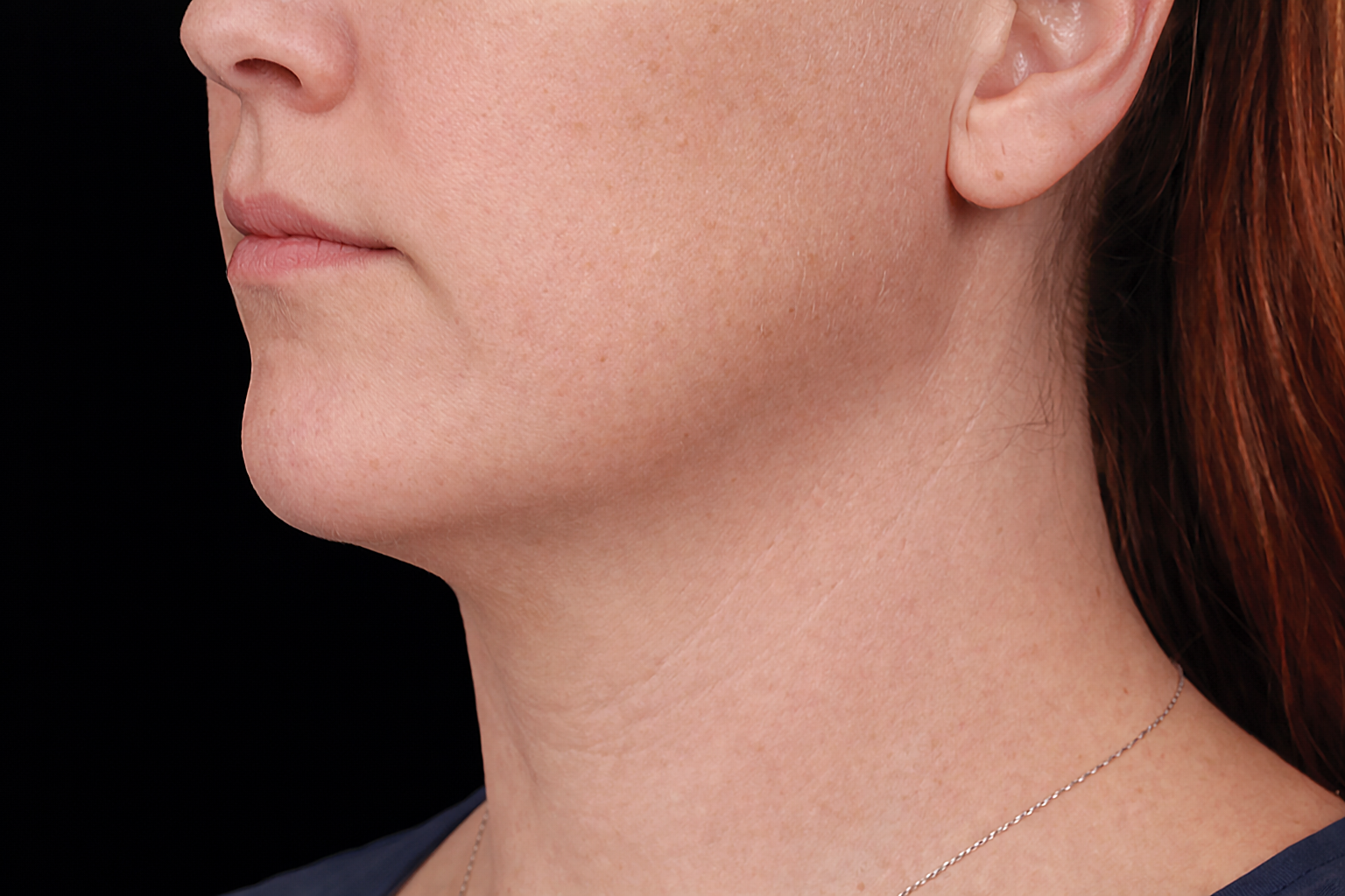 Profile view of a neck and jaw, with a slight double chin, against a black background.