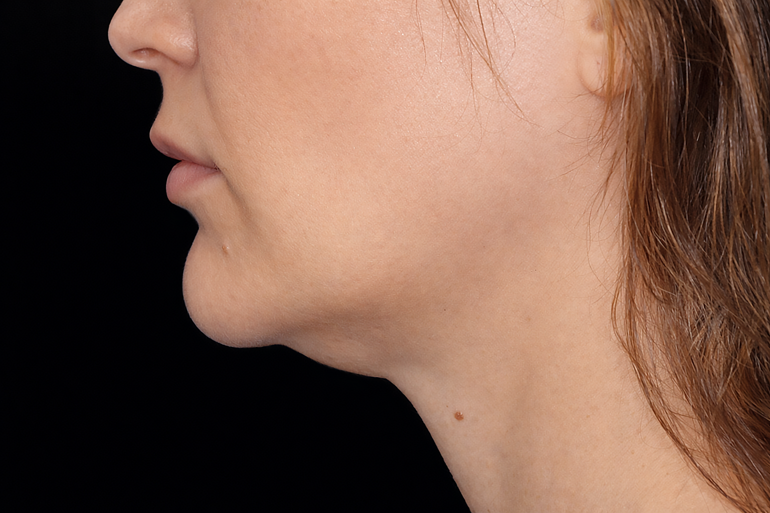 Profile of a person with a visible double chin, facing left with neutral expression.