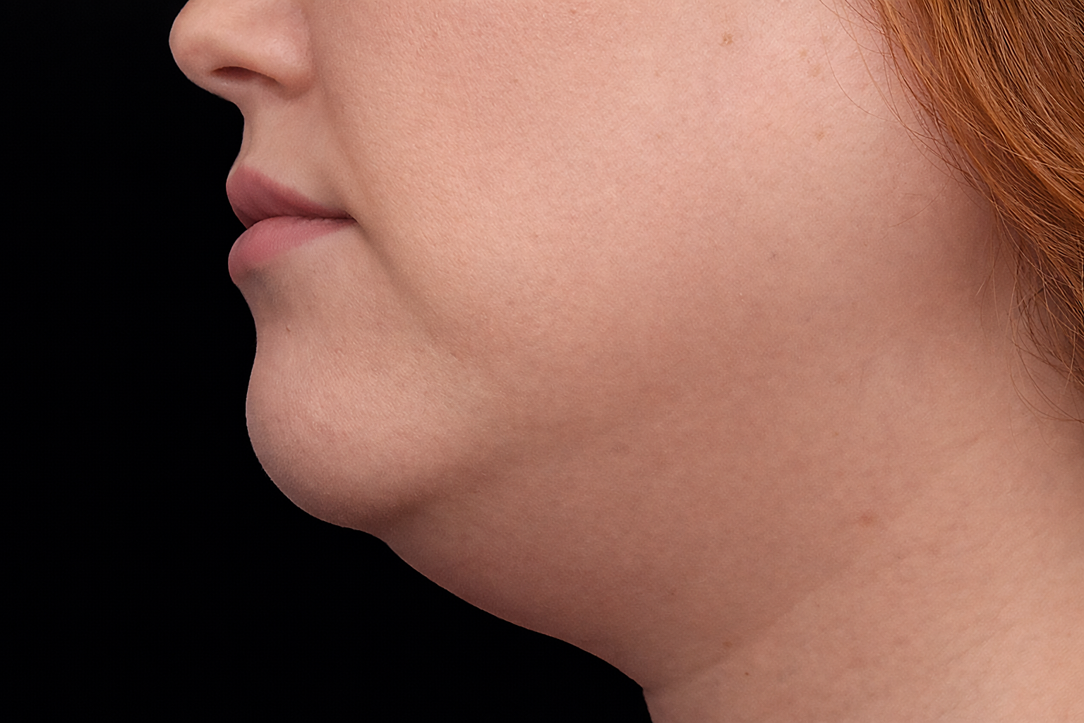 Profile view of a person's face and neck, with a visible double chin.
