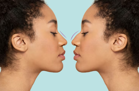 Como escolher o melhor cirurgião plástico para rinoplastia em São Paulo Como escolher o melhor cirurgião plástico para rinoplastia em São Paulo