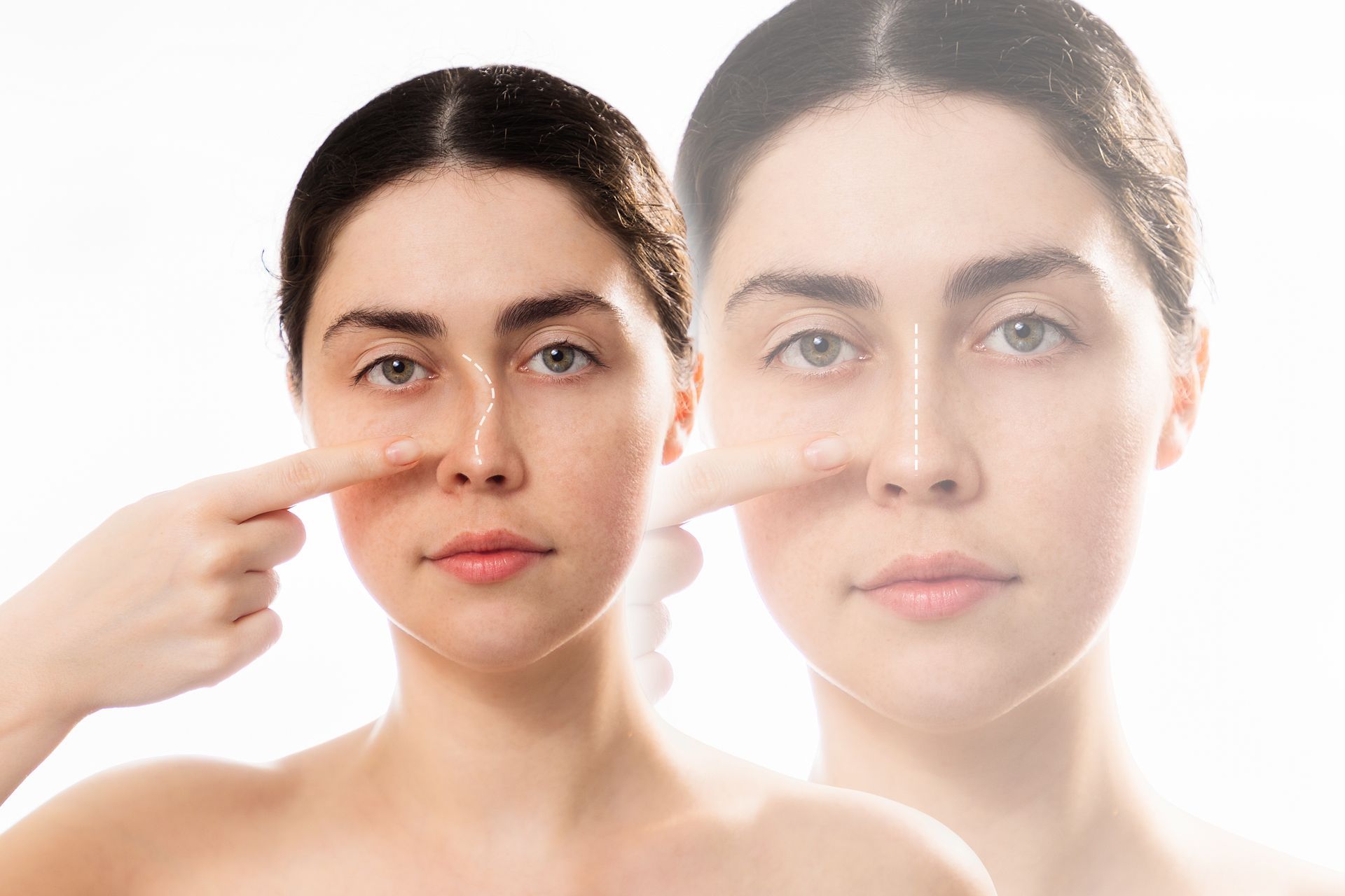 Como saber se preciso de uma rinoplastia secundária?