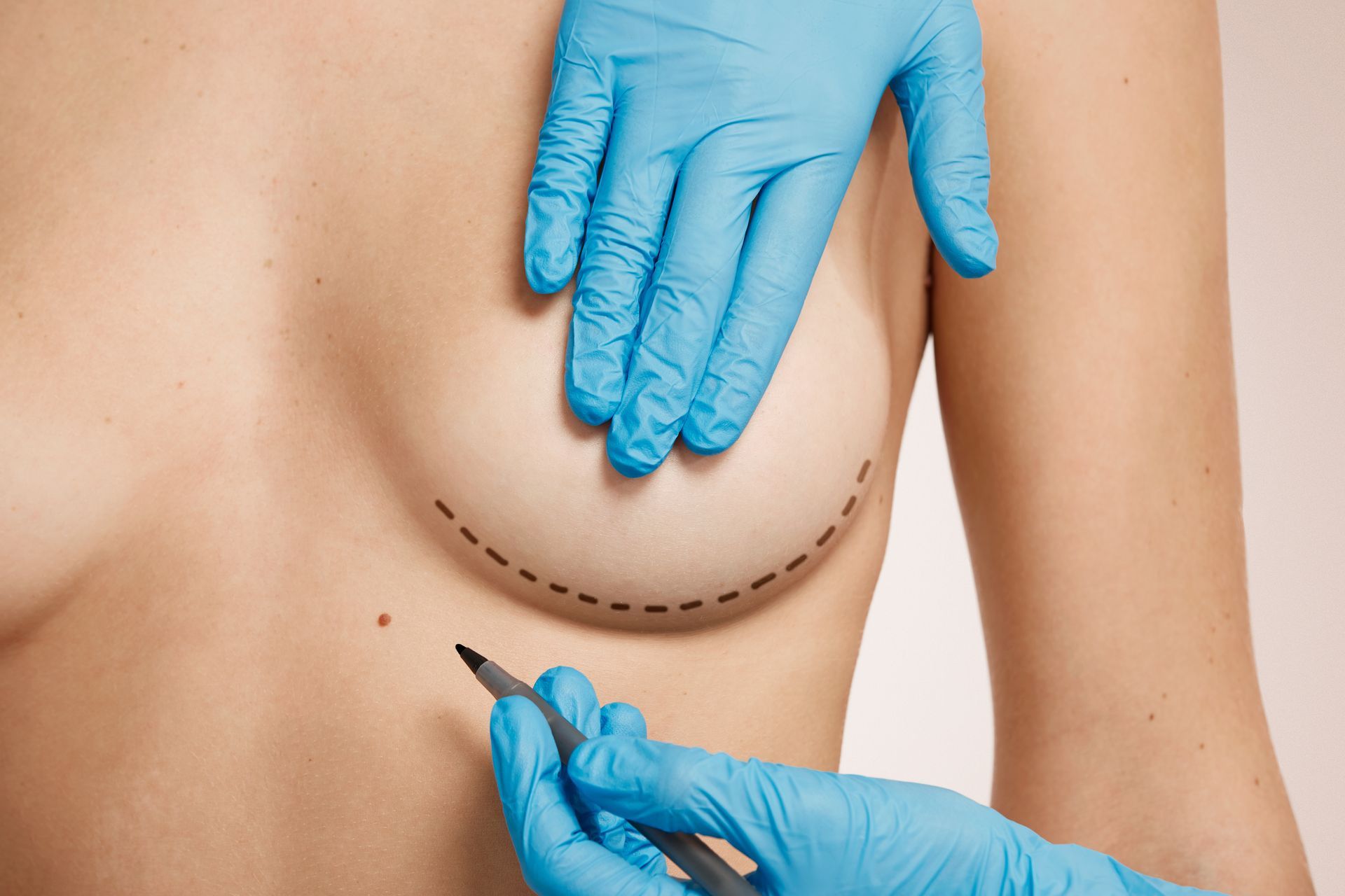 Onde fazer mamoplastia para correção de assimetria mamária em São Paulo