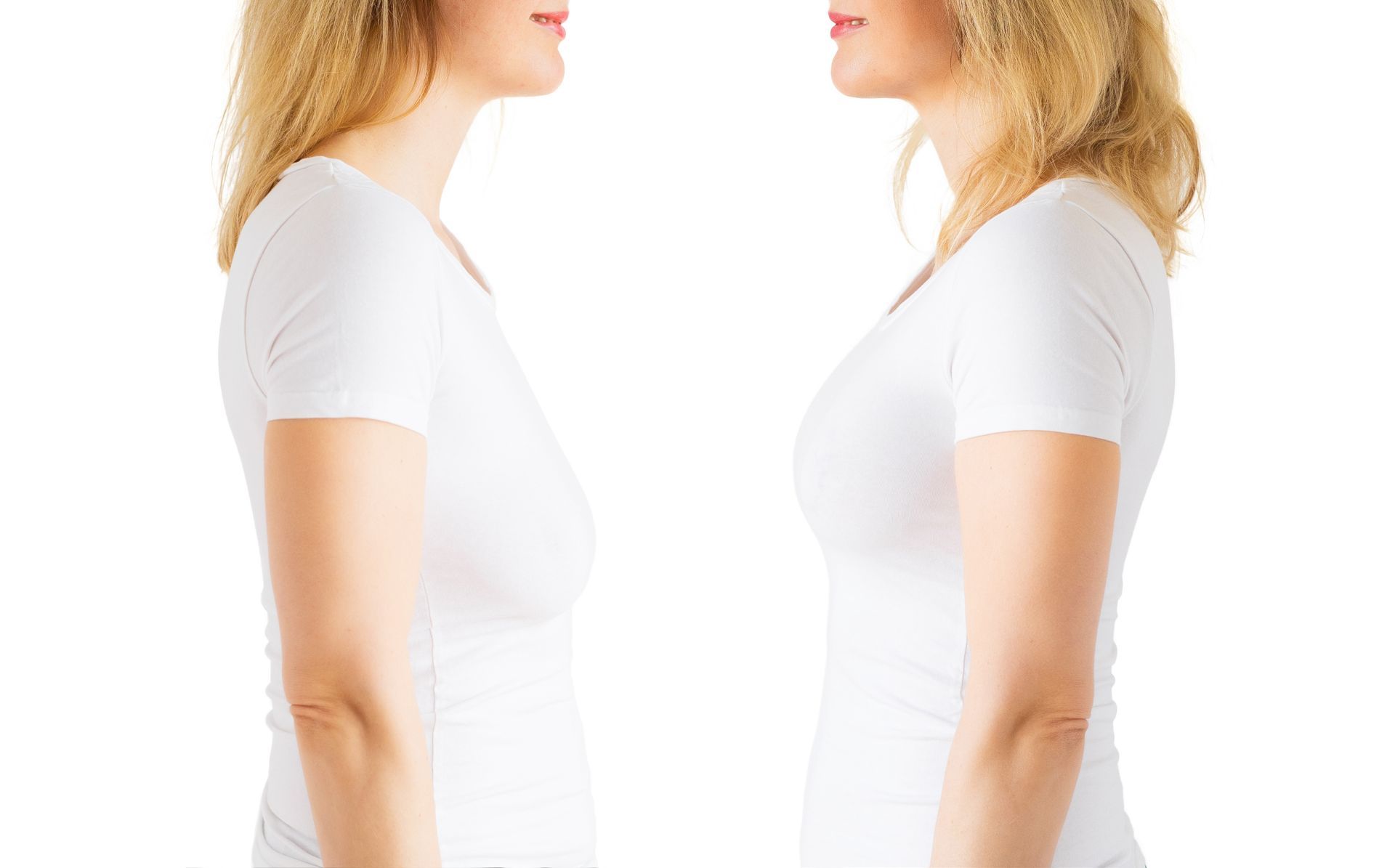 Quanto tempo para se recuperar da mamoplastia redutora