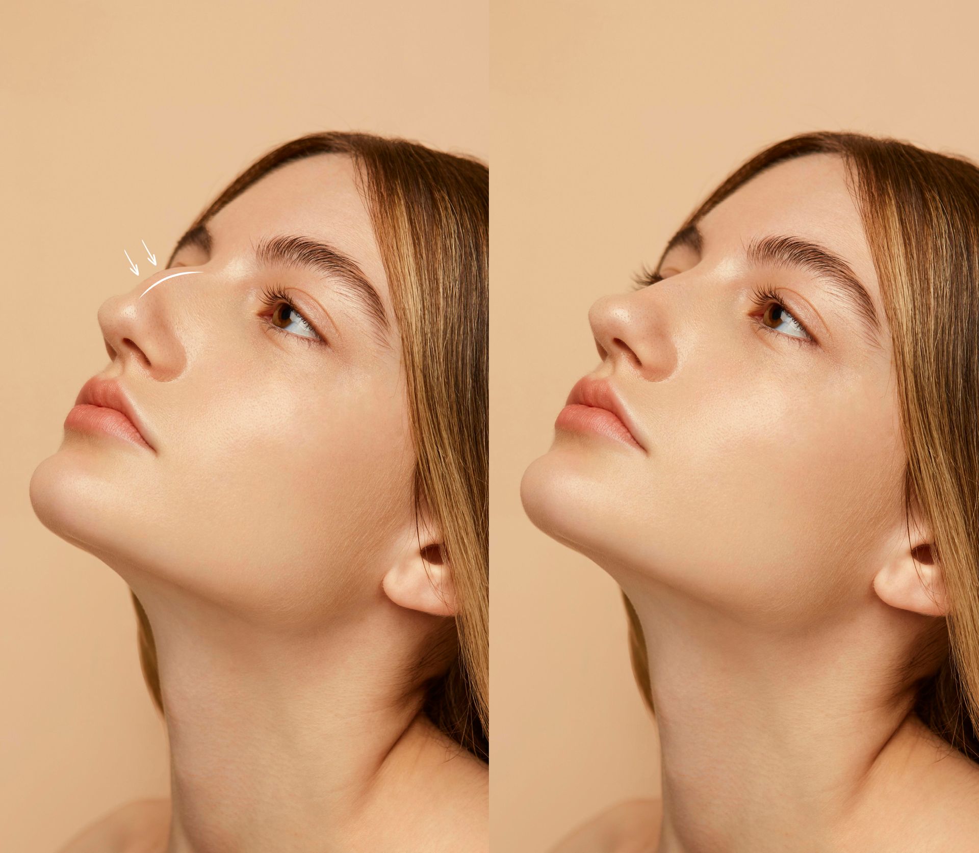 Rinoplastia com resultados naturais em São Paulo