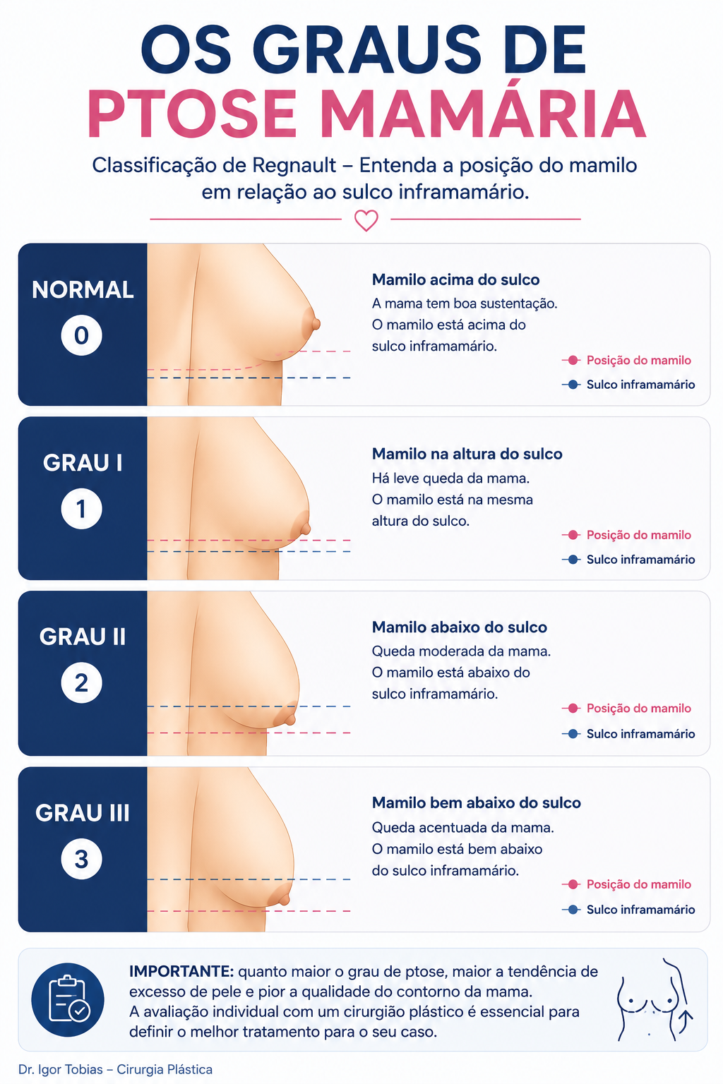 Infográfico mostrando os graus de ptose mamária segundo a classificação de Regnault, comparando a posição do mamilo em relação ao sulco inframamário nos graus normal, I, II e III.