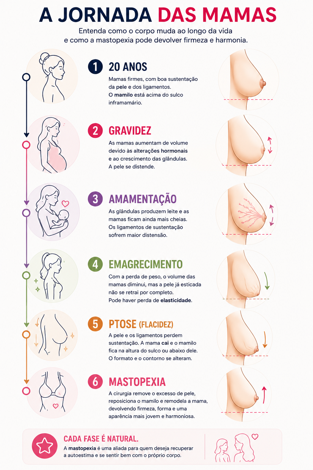 Infográfico mostrando a jornada das mamas ao longo da vida, desde a juventude, passando por gravidez, amamentação, emagrecimento e desenvolvimento da ptose mamária, até a correção da flacidez com mastopexia.