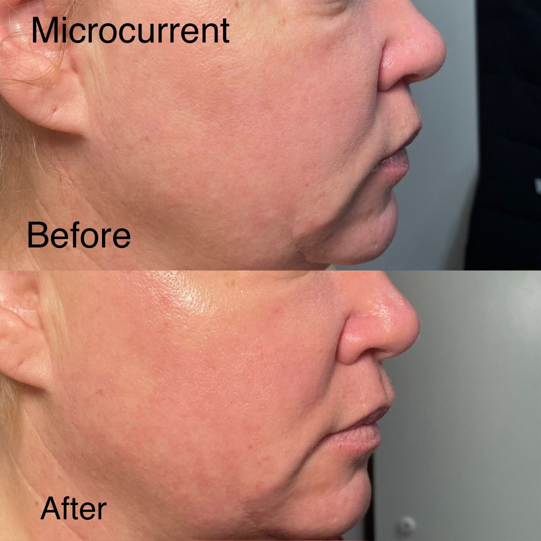 A woman 's face before and after microcurrent treatment.
