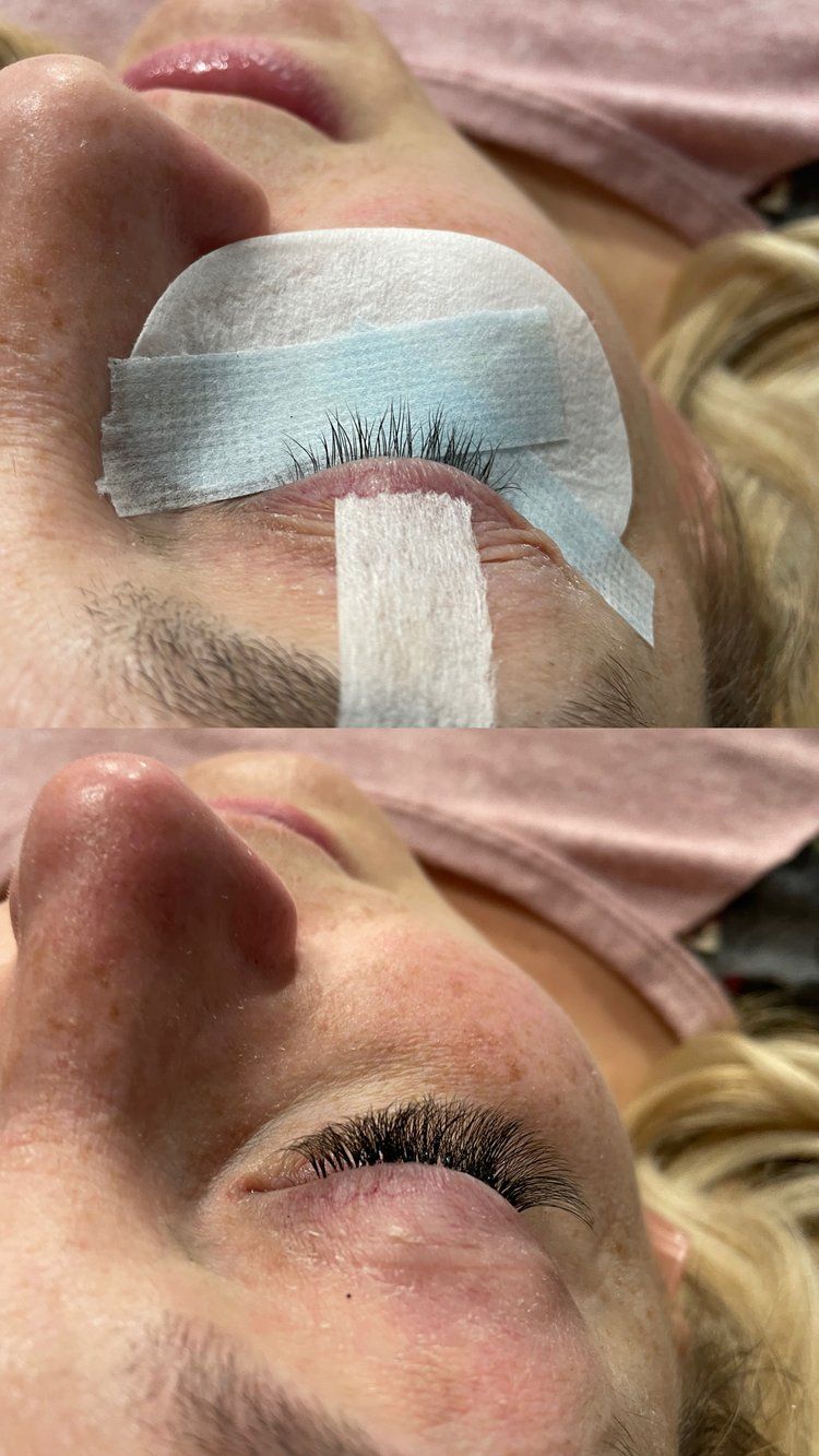 A woman is laying down with a bandage on her eye.