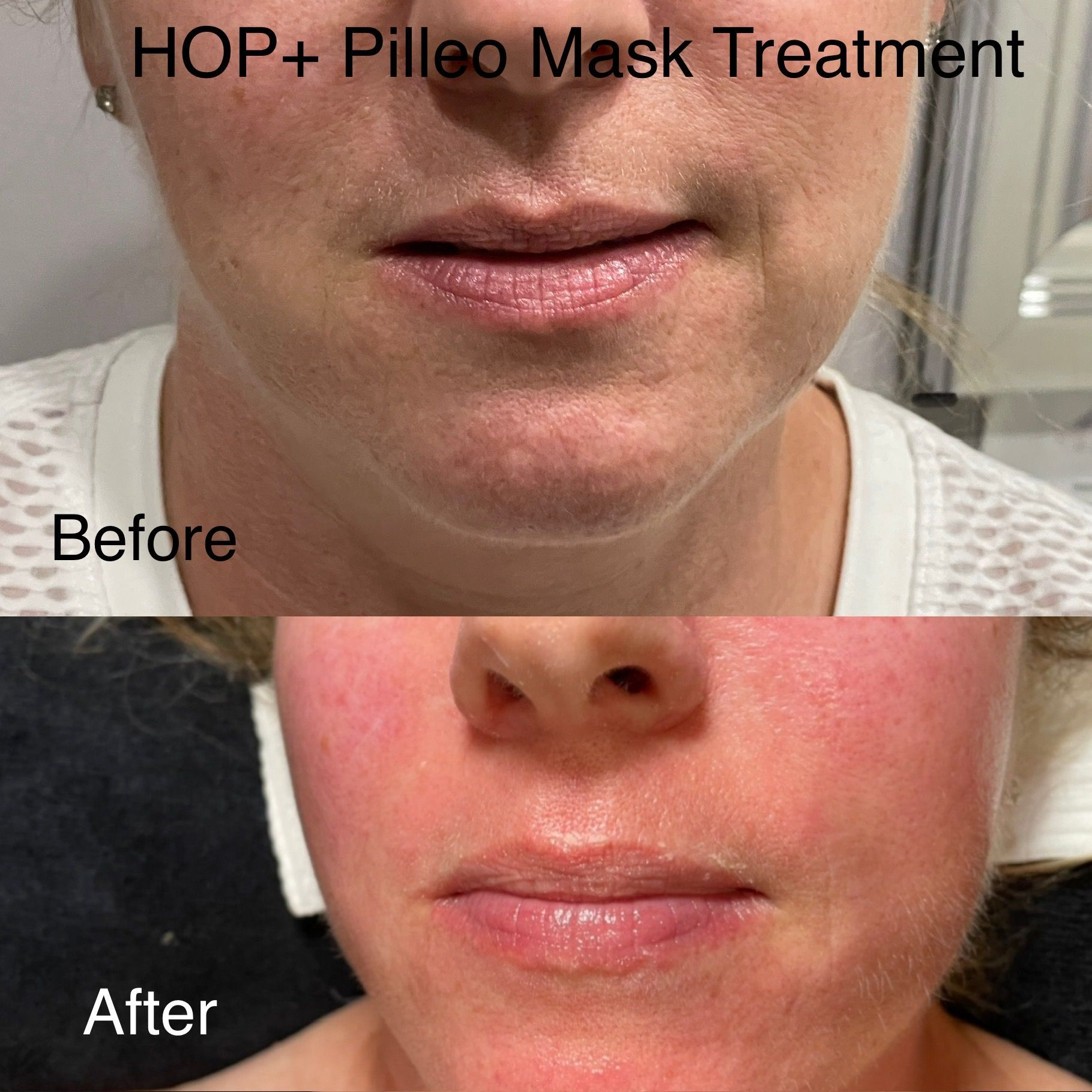 A woman 's face before and after a hop + pilleo mask treatment.