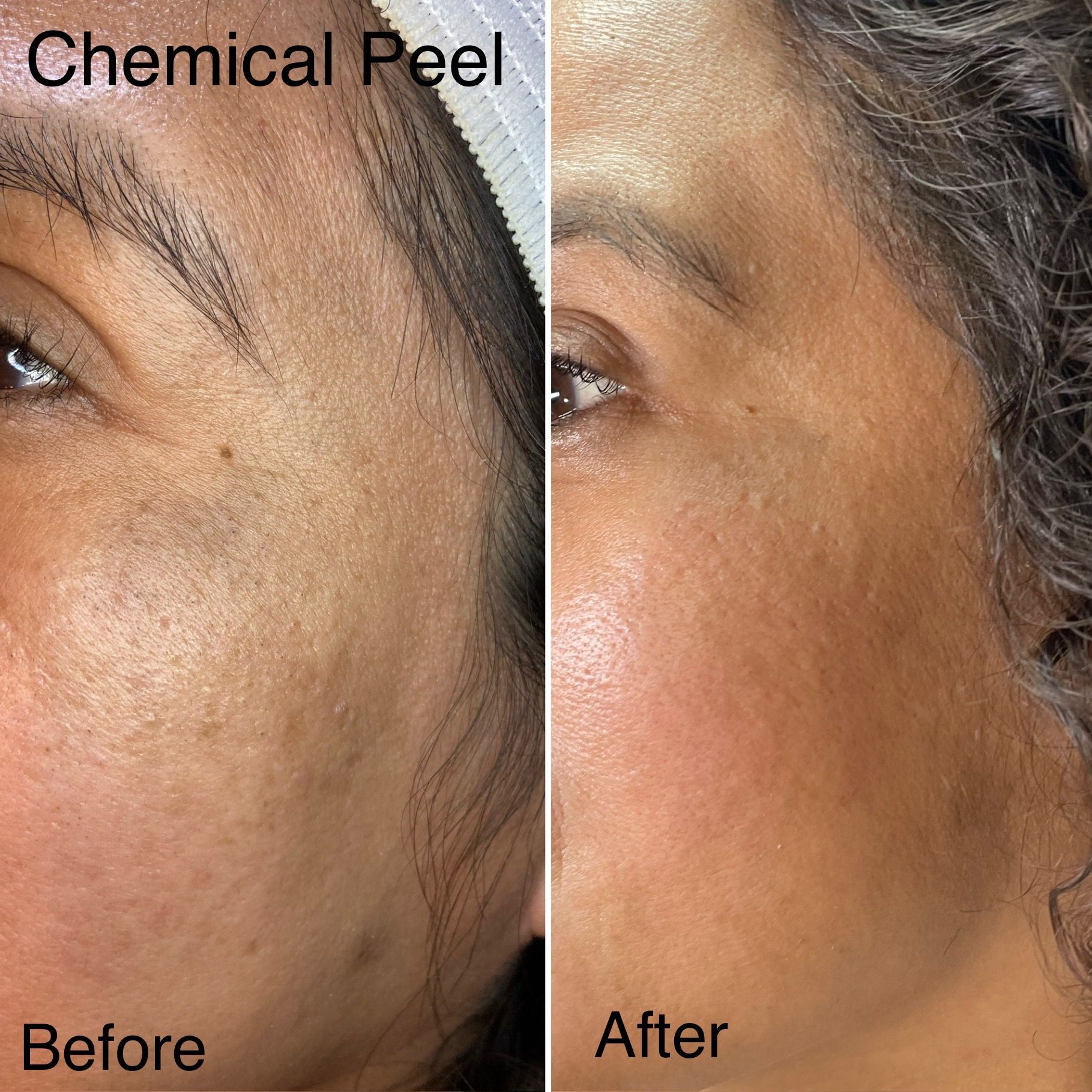 A woman 's face before and after a chemical peel.