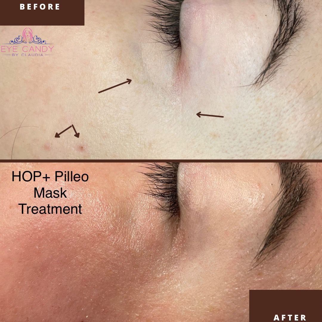 A woman 's face before and after a hop + pilleo mask treatment.