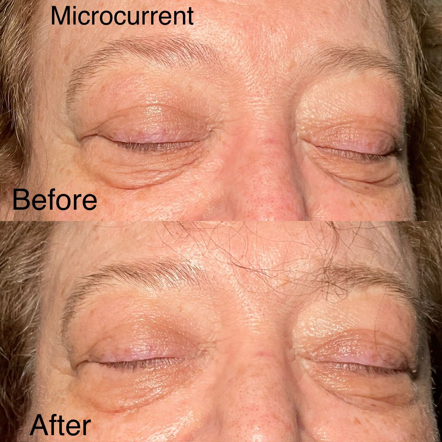 A woman 's face before and after microcurrent treatment