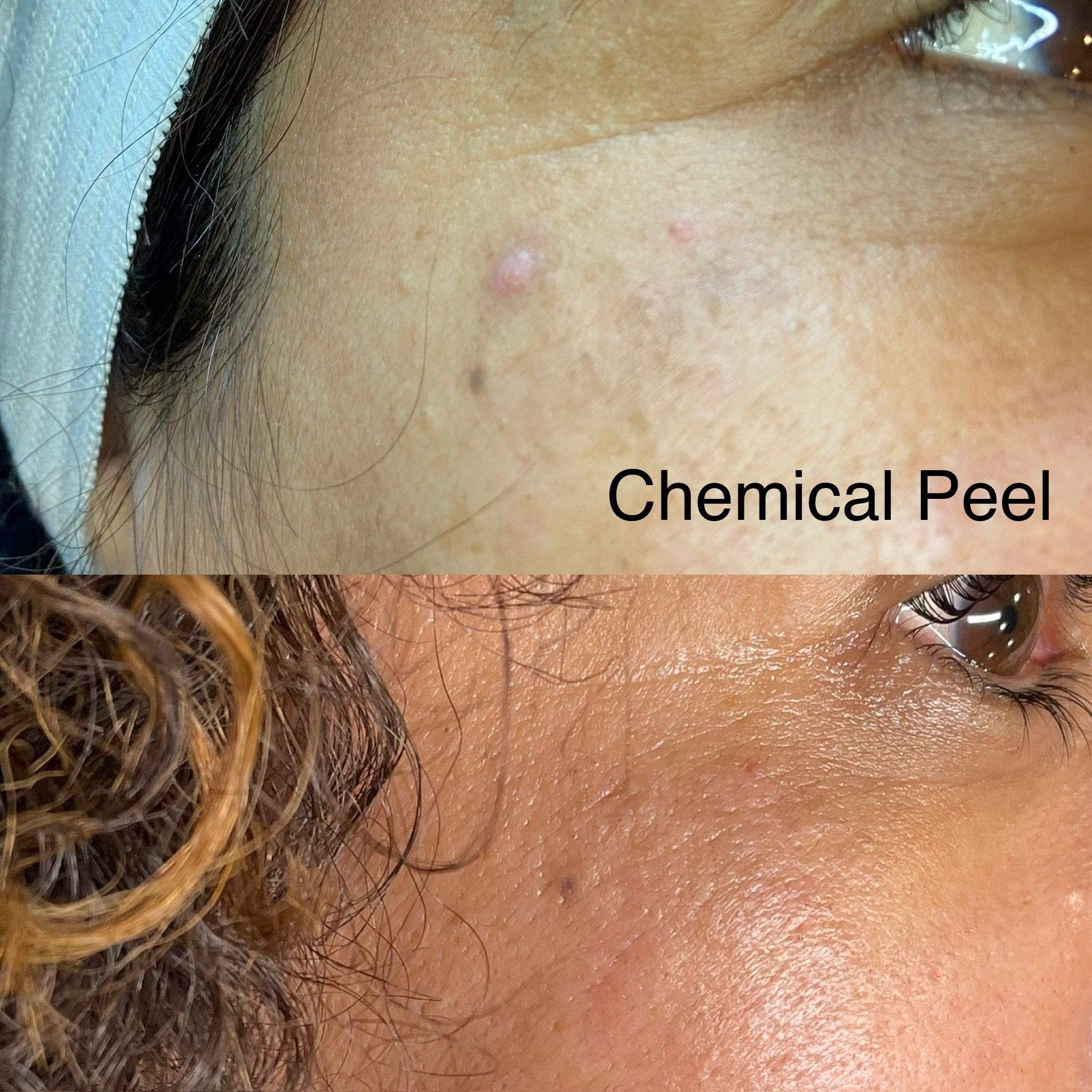 A woman 's face is shown before and after a chemical peel