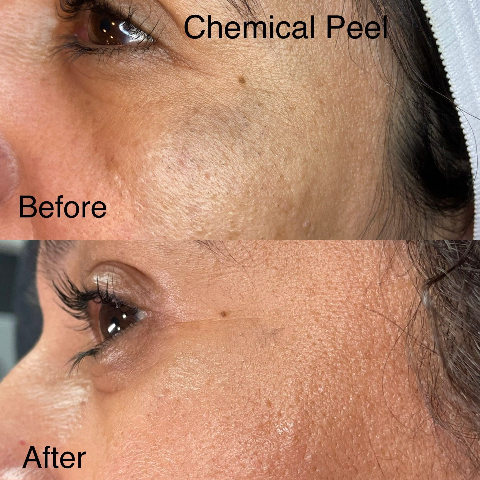 A woman 's face before and after a chemical peel.