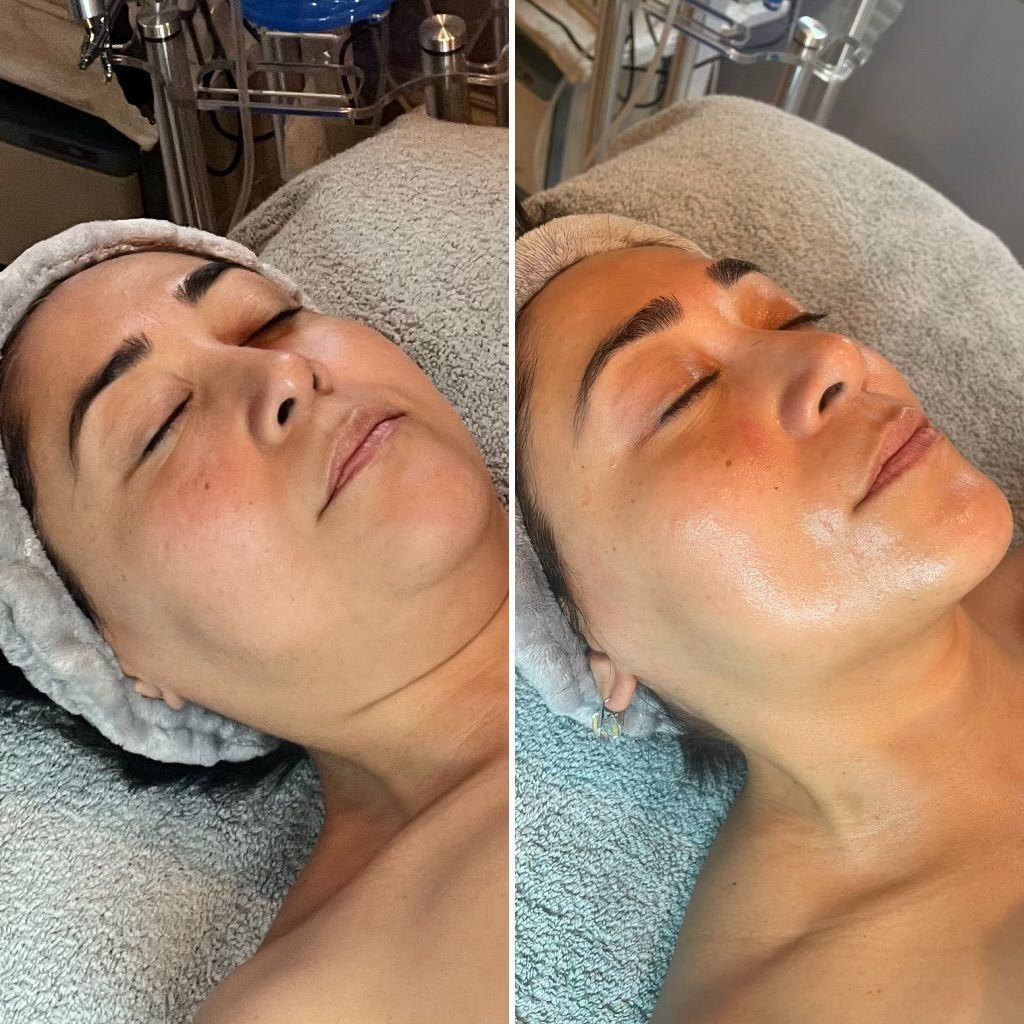 A before and after photo of a woman getting a facial treatment.