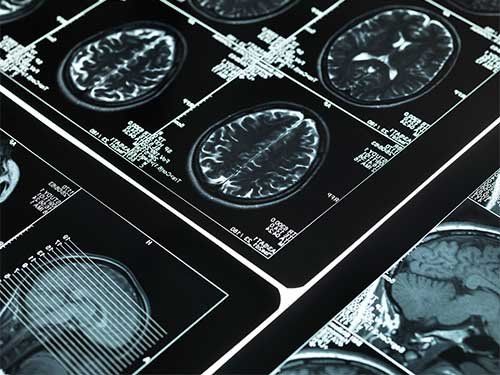 Common Symptoms of a Traumatic Brain Injury