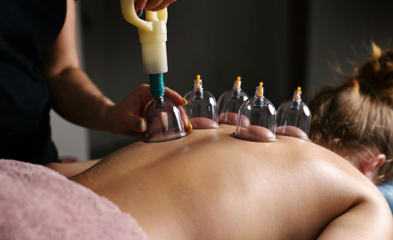 A woman is getting a cupping treatment on her back.