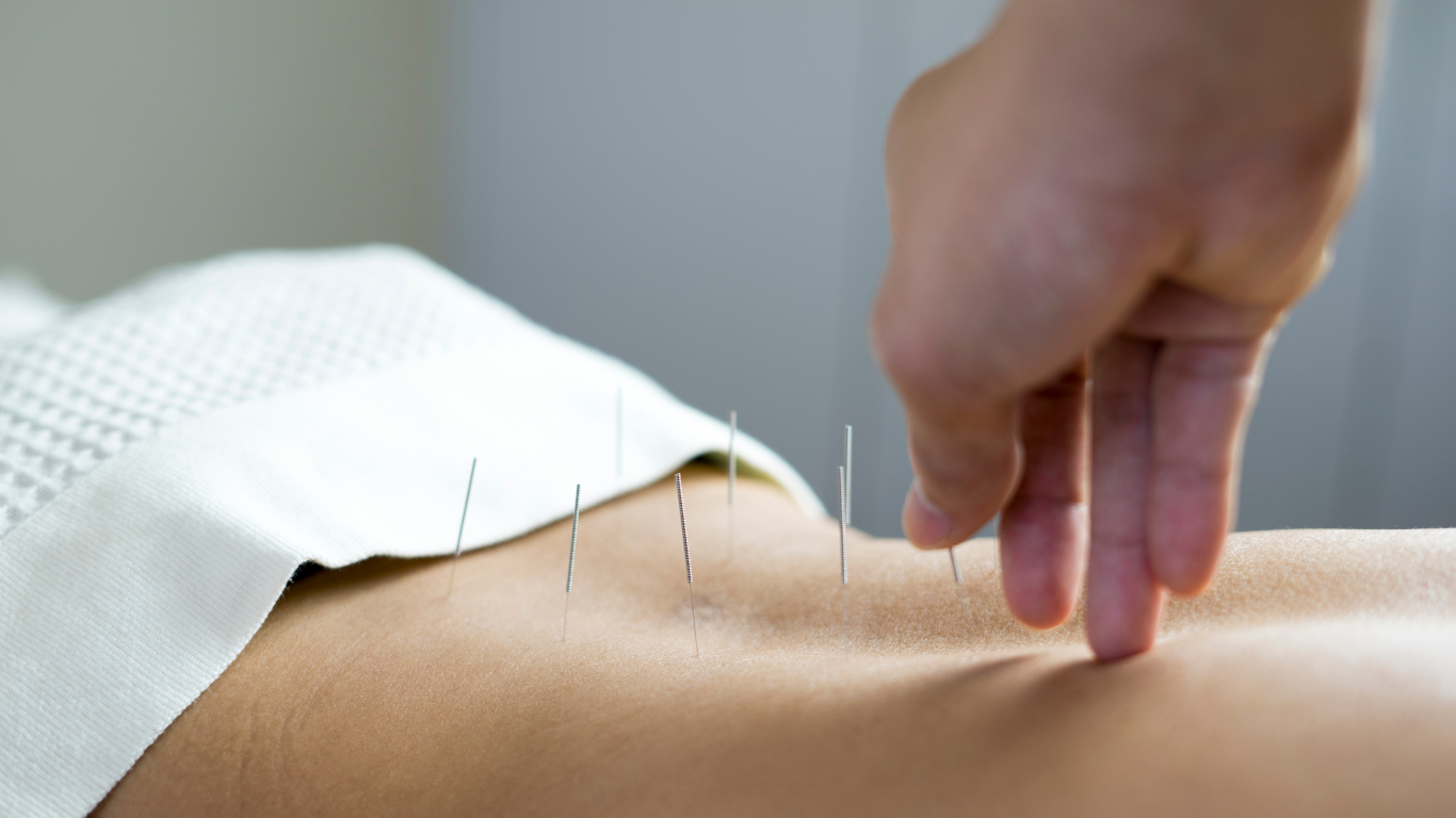 A person is getting acupuncture on their back.