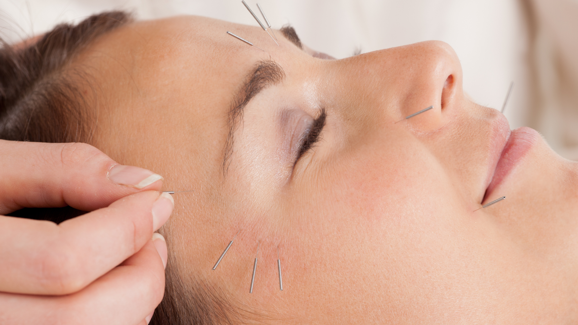 Woman receiving facial acupuncture treatment; needles inserted into skin.