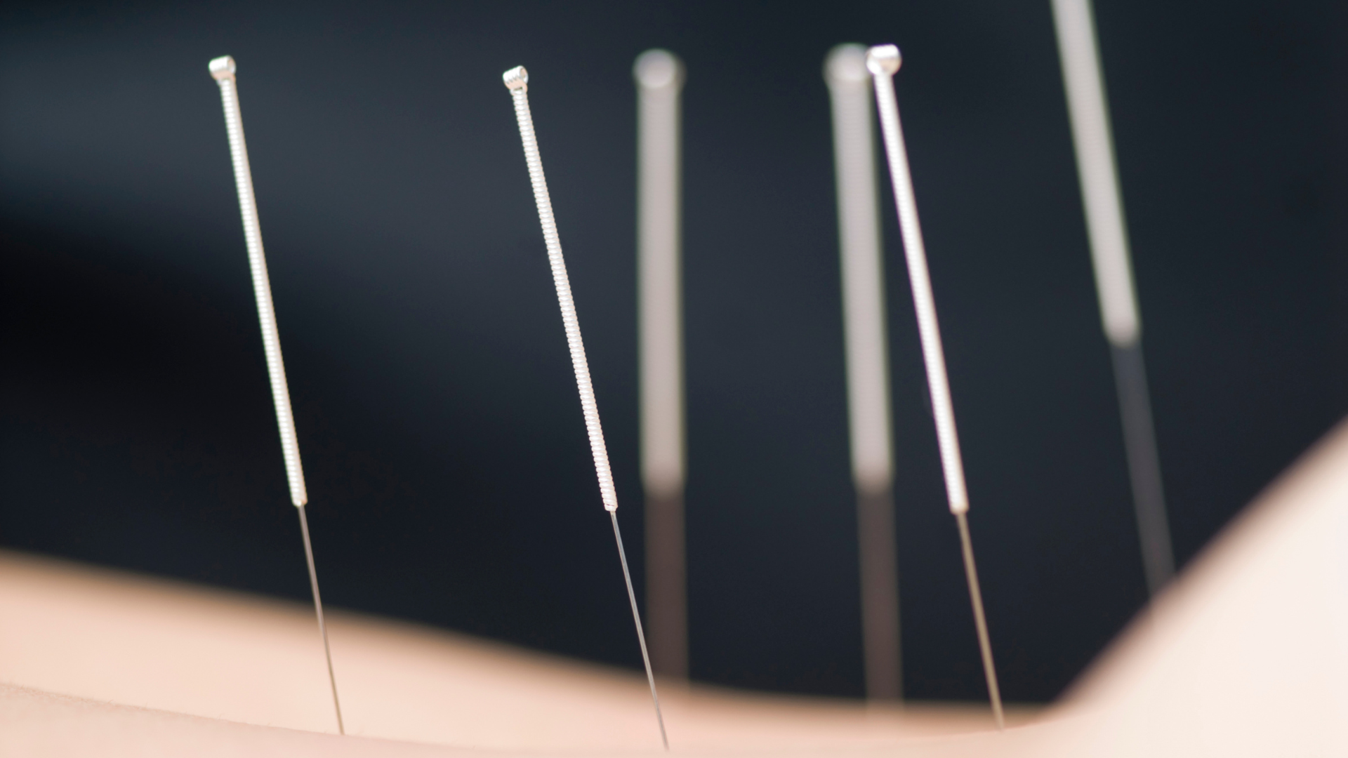 Four acupuncture needles are sitting on a black plate.