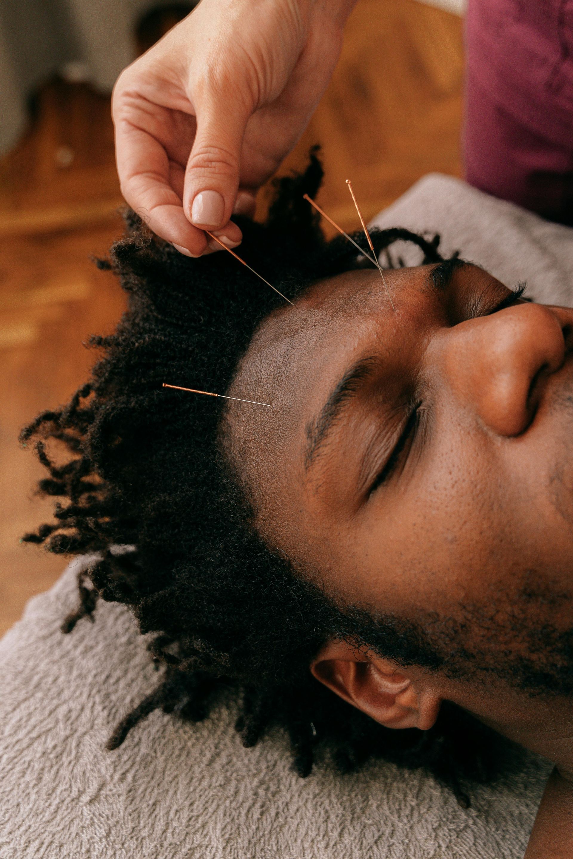 A person receiving facial acupuncture. Several needles are inserted into the forehead.