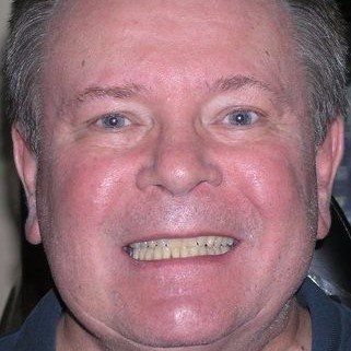 A man with braces on his teeth is smiling for the camera.