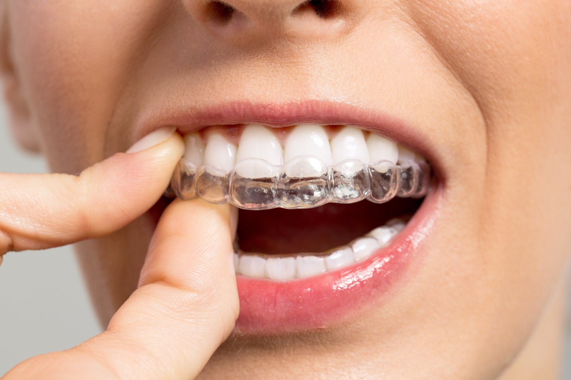 A woman is putting a clear brace on her teeth.