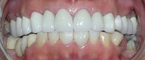 A close up of a person 's teeth with white teeth.