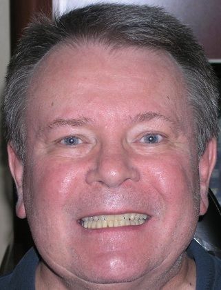 A man with braces on his teeth is smiling for the camera.