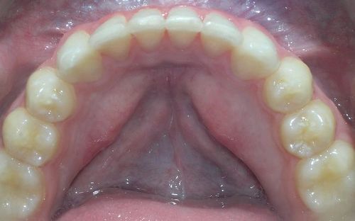 A close up of a person 's teeth and mouth.