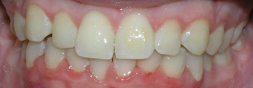 A close up of a person 's teeth with white teeth and red gums.