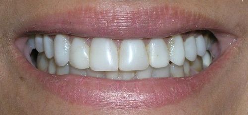 A close up of a woman 's mouth with white teeth.