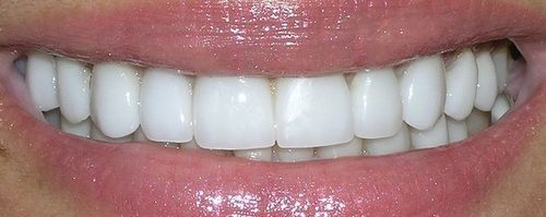 A close up of a woman 's smile with white teeth.