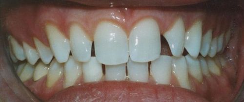 A close up of a person 's teeth with a broken tooth.