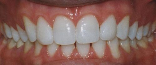 A close up of a person 's teeth with white teeth.