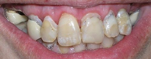 A close up of a person 's teeth with a broken tooth.