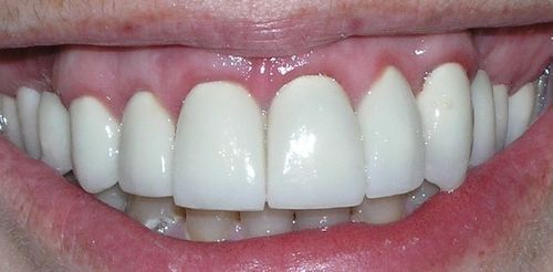 A close up of a person 's mouth with white teeth.