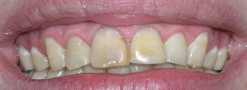 A close up of a person 's teeth with yellow spots on them.