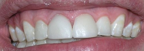 A close up of a person 's mouth with white teeth.