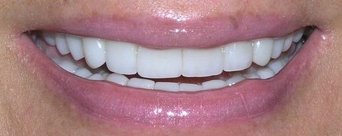 A close up of a woman 's smile with white teeth.