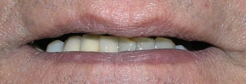 A close up of a man 's mouth with missing teeth.