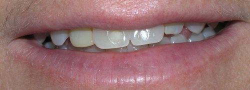 A close up of a person 's mouth with a broken tooth.